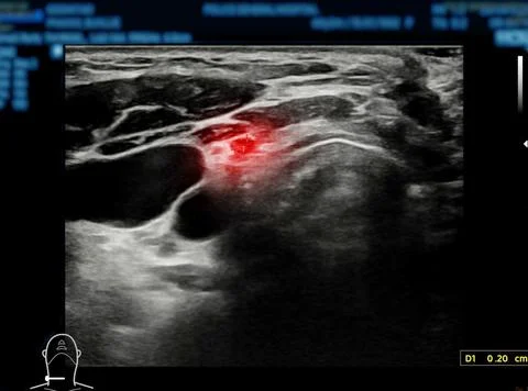 Ultrasonography of thyroid gland for diagnostics of the thyroid gland. Stock Illustration