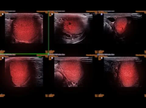 Ultrasonography of thyroid gland for diagnostics of the thyroid gland. Stock Illustration
