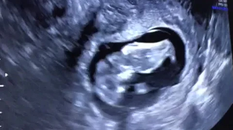 UltraSound of 11 week old Fetus Stock Footage