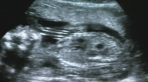 Ultrasound 22 weeks with heartbeat Stock Footage