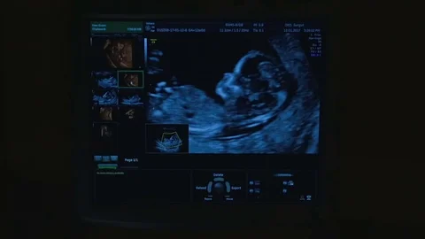 Baby In Womb Stock Video Footage Royalty Free Baby In Womb Videos Page 5