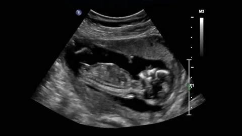 Ultrasound of baby body and spine. 12 w... | Stock Video | Pond5