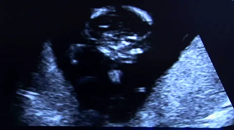 Ultrasound of baby Stock Footage