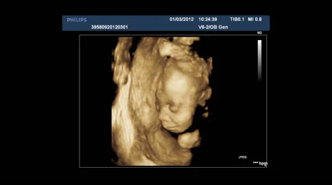 Ultrasound of the fetus during pregnancy Stock Footage