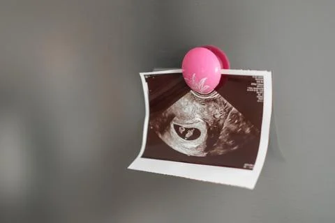 Ultrasound image of a developing fetus displayed on a refrigerator with a pink Fotos Stock