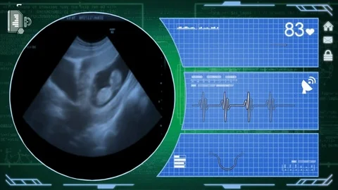 Ultrasound - Interface - medical screen - green Stock Footage