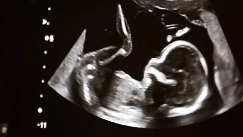 Ultrasound machine screen with unborn baby on it Stock Footage