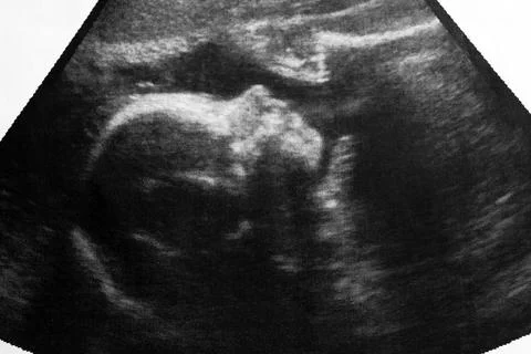 Ultrasound photo of unborn baby in mother's womb, closeup view Stock Photos