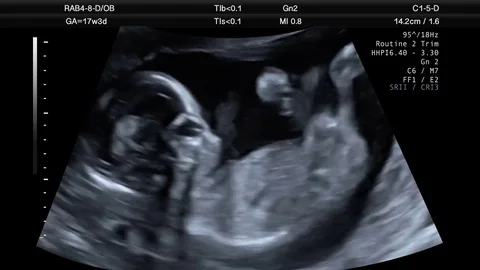 Ultrasound Scan Of 17 Week Old Fetus Stock Footage