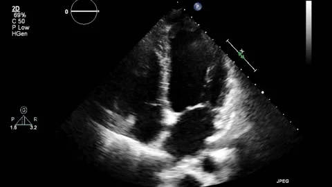 Ultrasound transesophageal examination of the heart. Stock Footage
