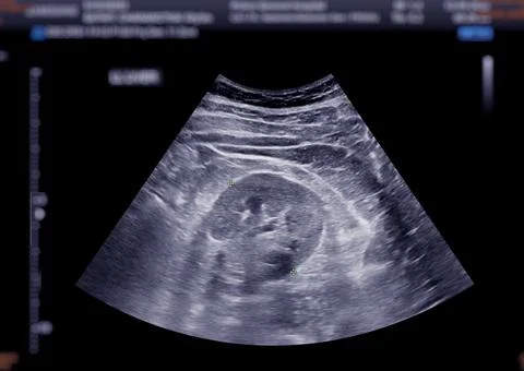 Ultrasound upper abdomen showing  kidney. Stock Illustration