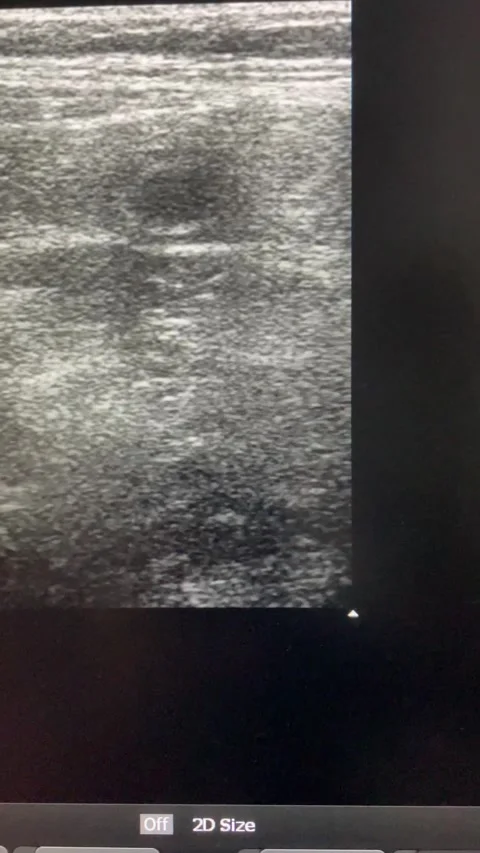 Ultrasound Visualization of the Appendix Stock Footage 288893708