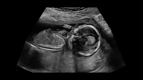 Ultrasound00 Stock Footage 336617714