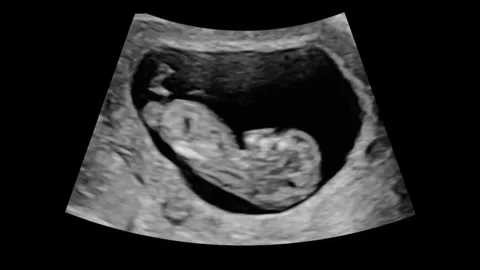Ultrasound01 Stock Footage 336618273