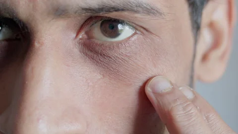 Under eye dark circle, eye bag Vidéo 303326148