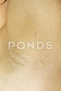Underarm skin stretchmarks Stock Photos