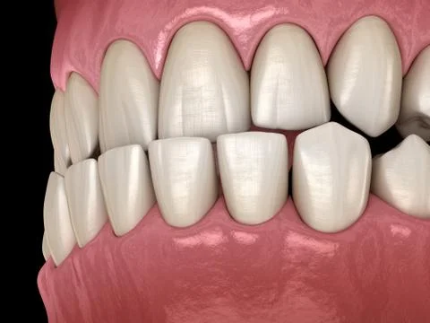 Underbite dental occlusion ( Malocclusion of teeth ). Medically accurate toot Stock Illustration
