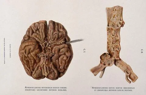Underside of a brain, shown beside a dissection of the abdominal aorta and .. Stock Illustration