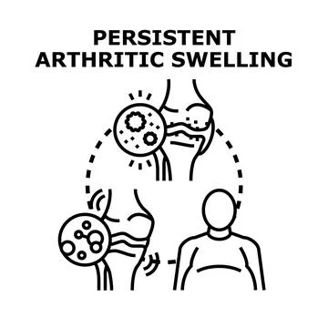 Understanding arthritic inflammation and joint swelling condition Stock Illustration