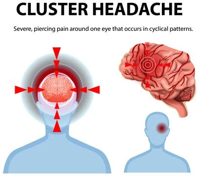 Understanding Cluster Headache Symptoms Stock Illustration