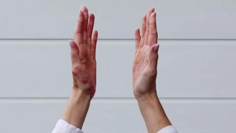 Understanding eczema, psoriasis, and dermatitis through personal skin challenges Stock Footage 317717326