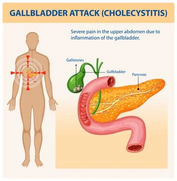 Understanding Gallbladder Attack and Cholecystitis Stock Illustration