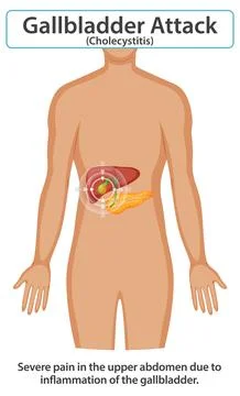 Understanding Gallbladder Attack Symptoms Stock Illustration