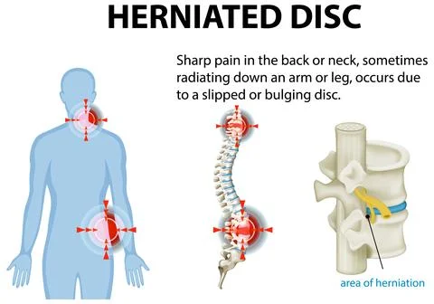 Understanding Herniated Disc Pain Stock Illustration