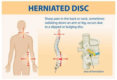 Understanding Herniated Disc Pain Stock Illustration