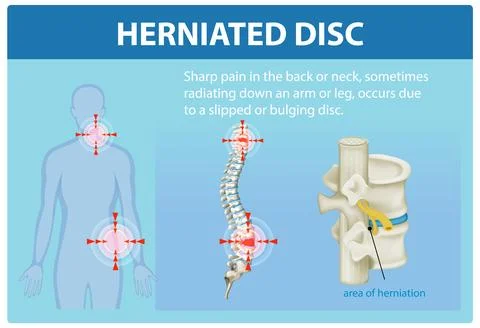 Understanding Herniated Disc Pain Stock Illustration