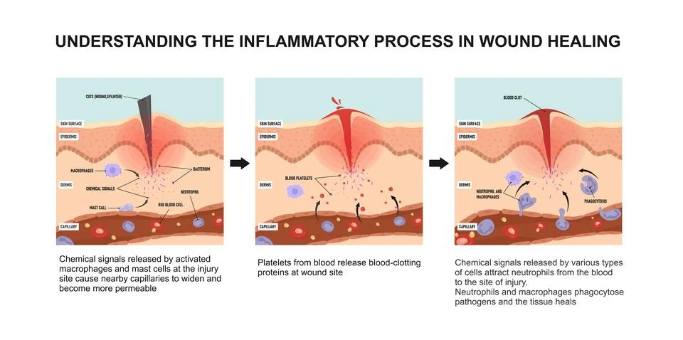 Understanding the inflammatory process in wound healing Stock Illustration