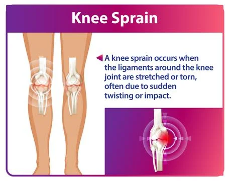 Understanding Knee Sprain and Its Causes Stock Illustration