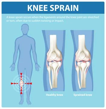 Understanding Knee Sprain and Its Effects Stock Illustration