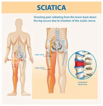 Understanding Sciatica and Its Symptoms Stock Illustration