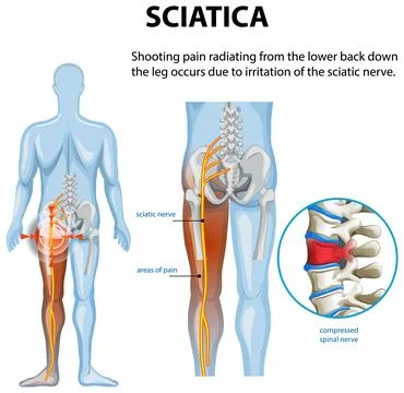 Understanding Sciatica and Its Symptoms Stock Illustration