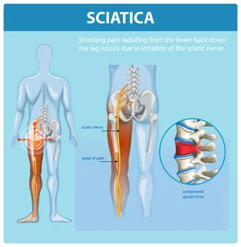Understanding Sciatica and Its Symptoms Stock Illustration