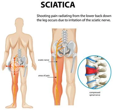 Understanding Sciatica and Nerve Pain Stock Illustration