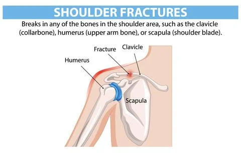 Understanding Shoulder Fractures Stock Illustration