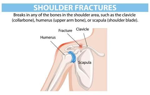 Understanding Shoulder Fractures Stock Illustration