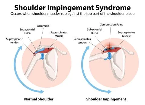 Understanding Shoulder Impingement Syndrome Stock Illustration