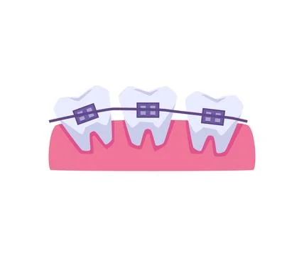 Uneven row of teeth with braces flat style, vector illustration Stockillustratie