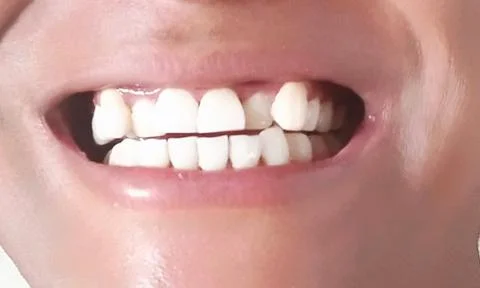 Uneven teeth Stock Photos