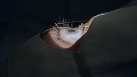 Unique Macro close-up shot of cataract eye surgery Stock Footage 146377206