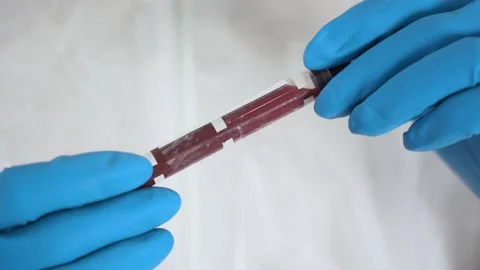 Unknown human medic holds, turns test tube with blood, inscription 2019-nCoV Stock Footage 131478719