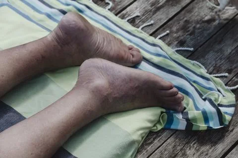 An unrecognizable elderly man with bare legs, revealing varicose veins spider Photos