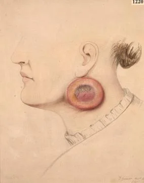 Unusual round-celled sarcoma occurring at the angle of the jaw of a woman Stock Illustration