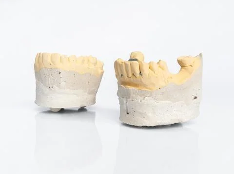 Upper and lower dental plaster casts for prosthetic planning Stock Photos