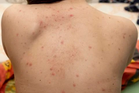 Upper back of young woman contracted chickenpox and red rash spilled on her skin Stock-Fotos