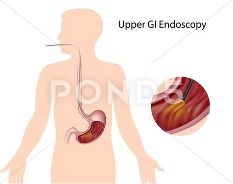 Upper gastrointestinal endoscopy Stock Illustration