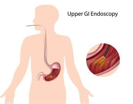 Upper gastrointestinal endoscopy Stock Illustration